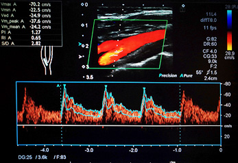 Duplex sonography