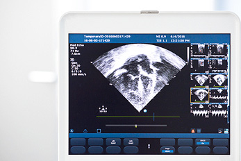 Stress echocardiography